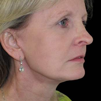 after deep-plane-facelift-laser-resurfacing